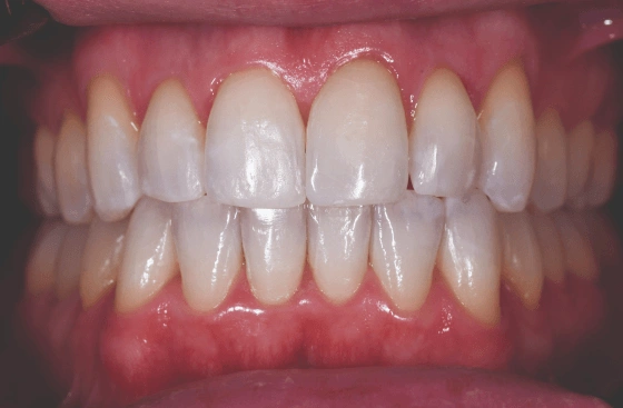 Invisalign offer a4