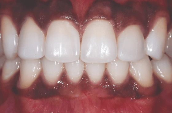 Invisalign offer a5