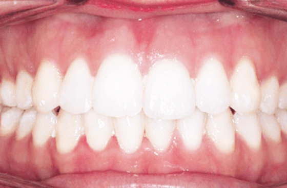 Invisalign offer a6