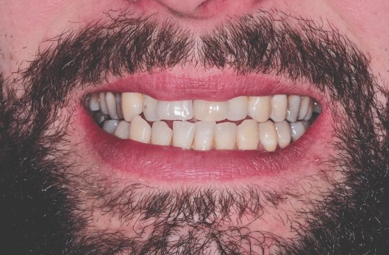 Invisalign offer b1