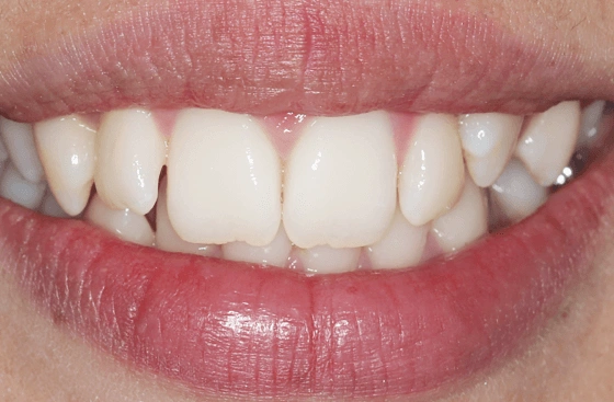 Invisalign offer b2