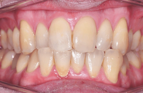 Invisalign offer b4