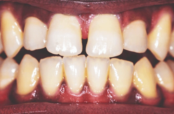 Invisalign offer b5