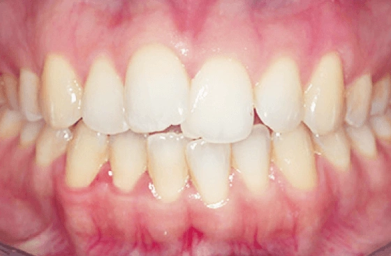 Invisalign offer b6