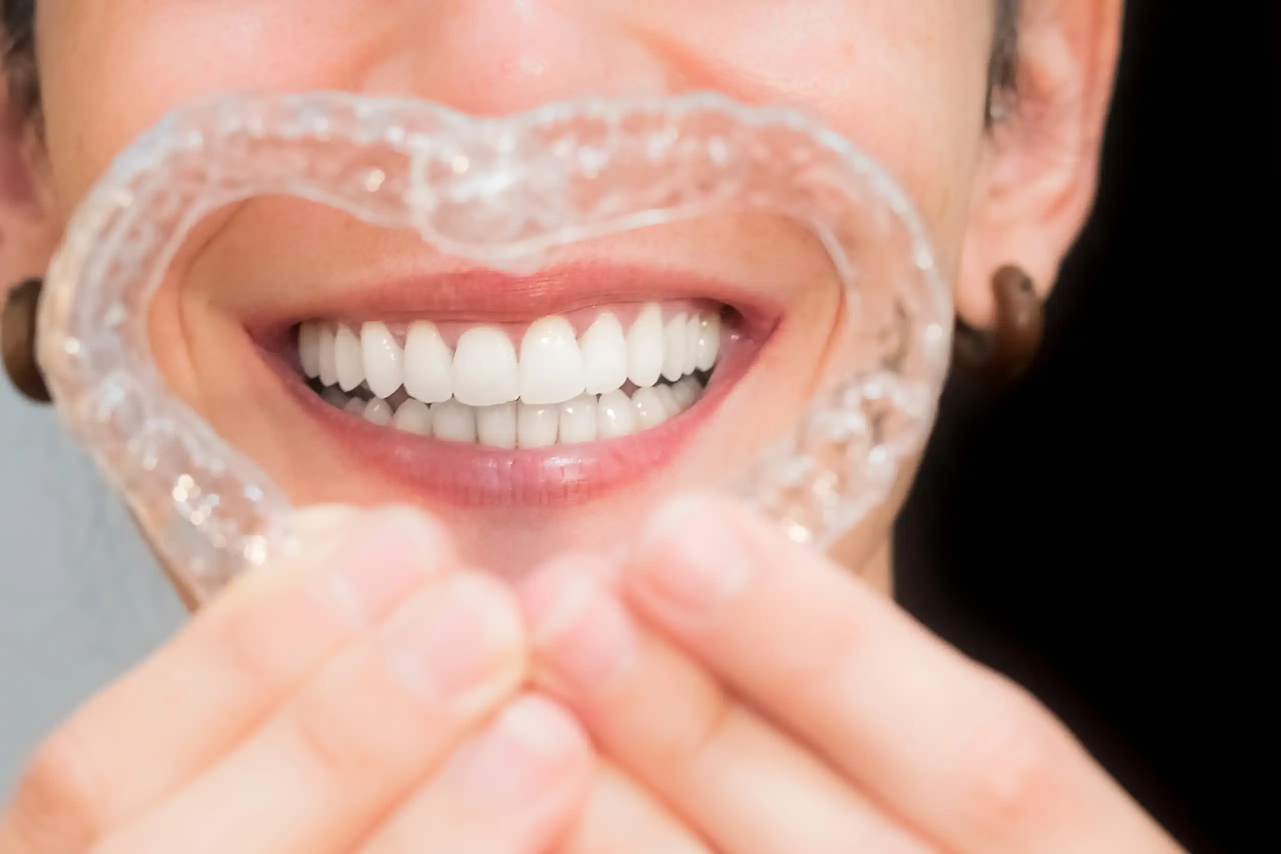 Invisalign vs. Candid CO Clear Aligners: What’s the Difference?