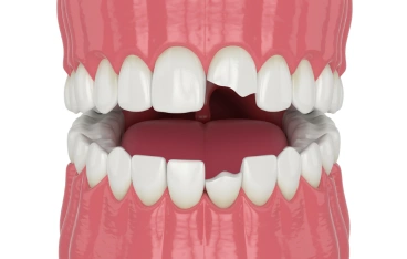 Irregularly Shaped Teeth
