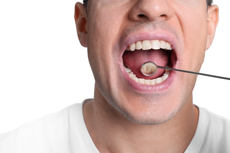 Factors that Increase the Risk of Oral Cancer