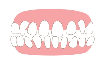 Small Unwanted Gaps