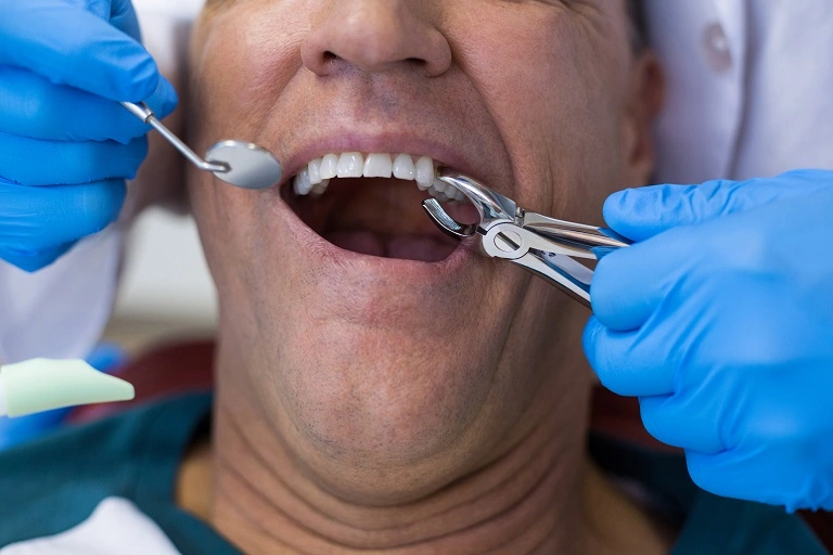 Home Care And Pain Management Tips After Tooth Extraction