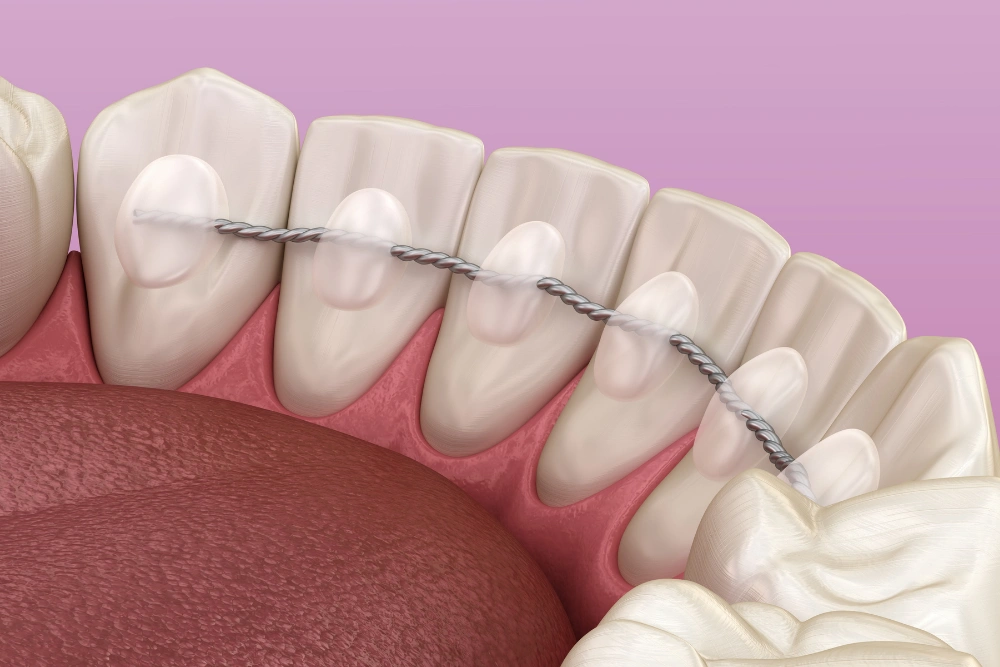 retainers