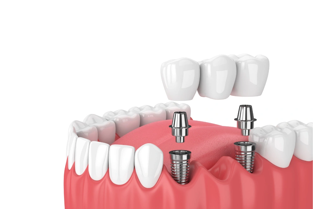 Dental Bridge