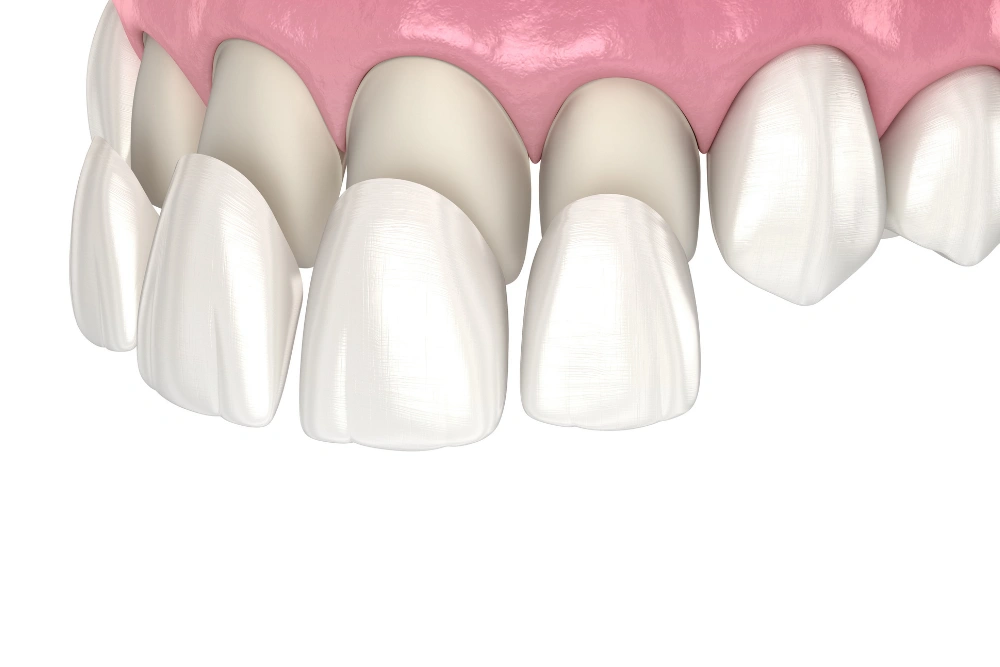 veneers