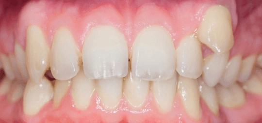 Invisilign before