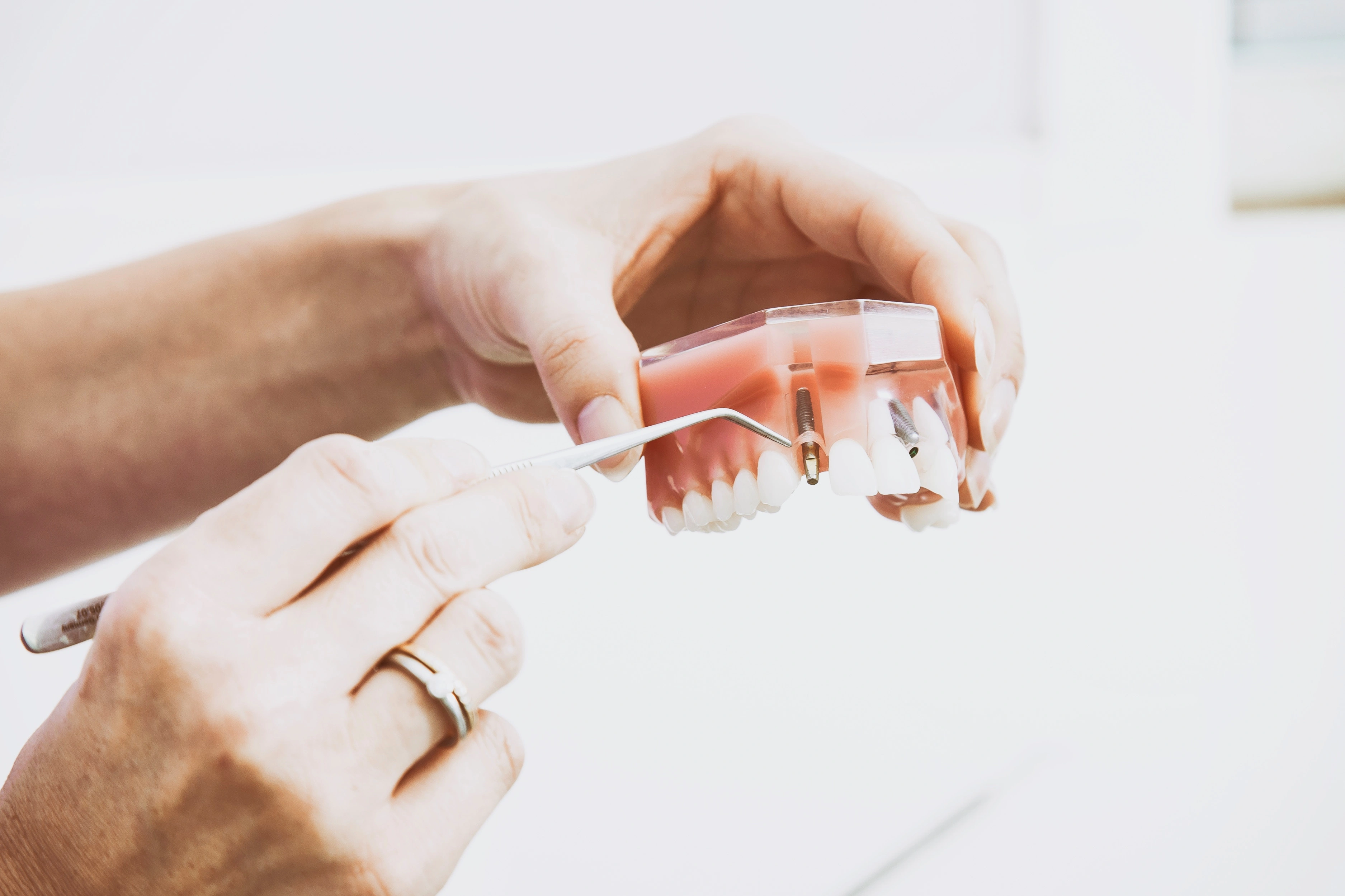 Dental Implant Screw