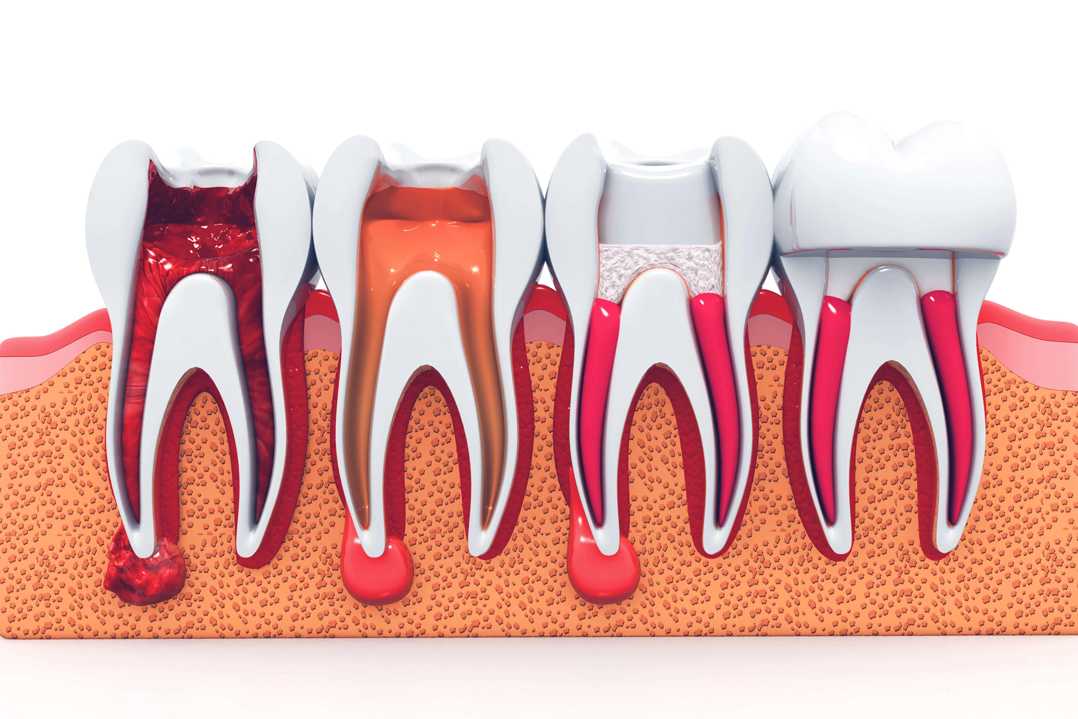 When is a root canal needed