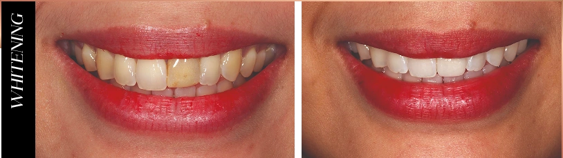 Smile 4