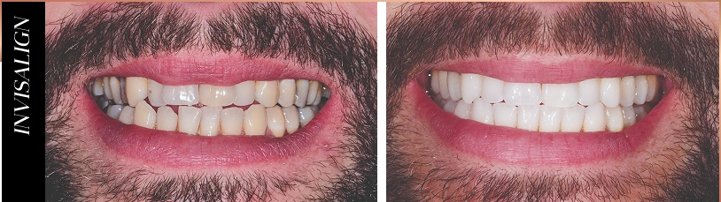Smile 5