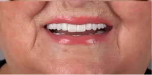 After Dental Implant Treatment