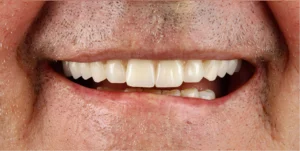 After Dental Implants