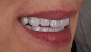 After Dental Treatment