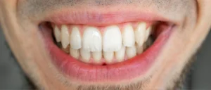 After Invisalign Treatment