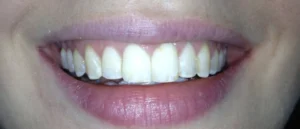 Aligners After