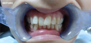 Aligners Before