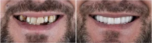 Before Dental Implant