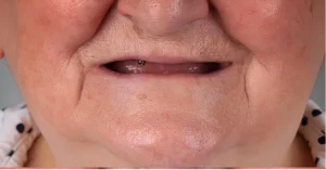 Before Dental Implant Treatment