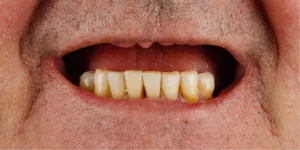 Before Dental Implants