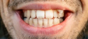 Before Invisalign Treatment