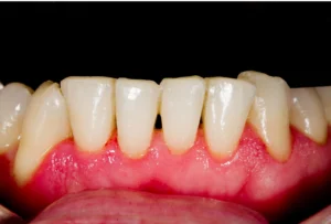 Dental Hygiene After