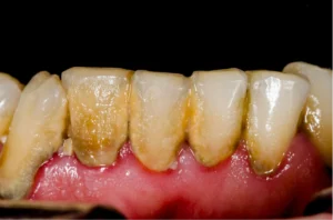Dental Hygiene Before