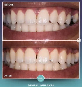 Dental Implant After