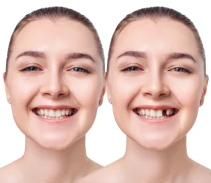 Dental Implant Consultation