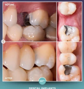 Dental Implant Treatment
