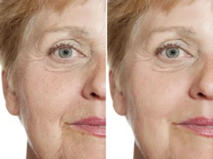 Facial Filler Treatment