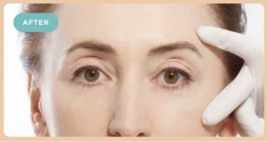 Facial Fillers After