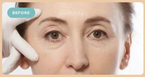 Facial Fillers Before
