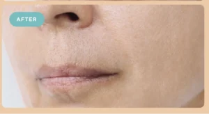 Fillers After
