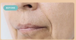 Fillers Before