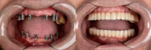 Full Mouth Dental