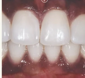 Invisalign After Results