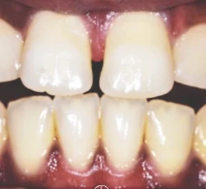 Invisalign Before Results