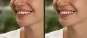 Invisalign Treatment