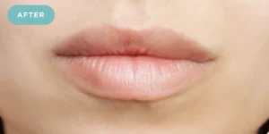 Lip Filler After