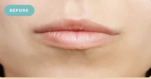 Lip Filler Before