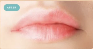 Lip Fillers After