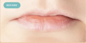 Lip Fillers Before