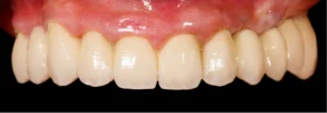 Multiple Dental Implants